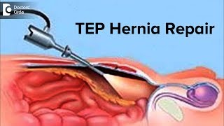 Hernias in Women  Symptoms and Treatments [upl. by Aneema]