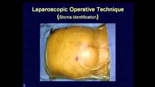 Medical Coding for Hernia Repair  Medical Coding Tips [upl. by Berfield458]