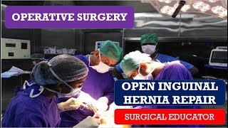 Complex Hernia Repair  Hernia Program at Penn Medicine [upl. by Lyreb]