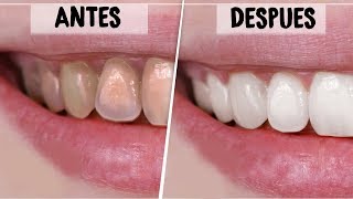 ¡DIENTES BLANCOS EN 2 MINUTOS REMEDIOS CASEROS Y NATURALES PARA BLANQUEAR LOS DIENTES  Vania [upl. by Aseretairam]