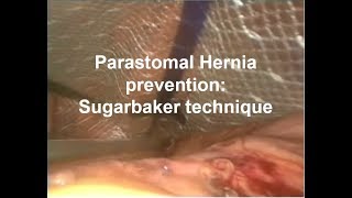 Parastomal Hernia Prevention Sugarbaker technique [upl. by Nies]